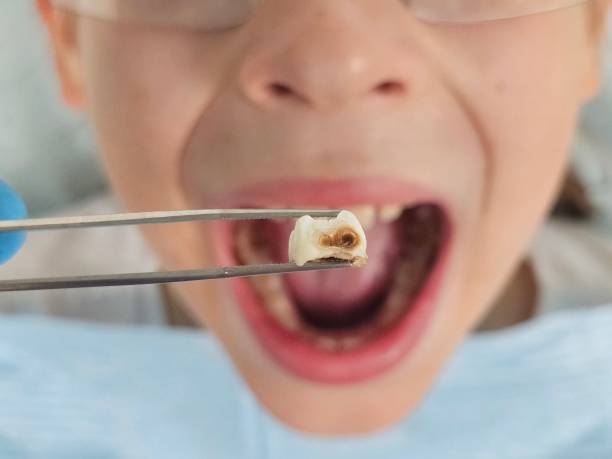 Best Emergency Treatment for Oral Infections in Fruitland, MD